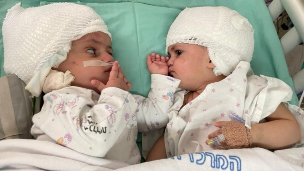 Fejüknél összenőtt ikerbabákat választottak szét sikeresen Izraelben
