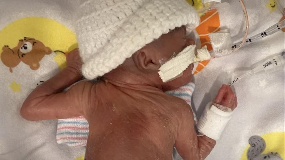 Valóságos csoda: egy százalék esélye sem volt, mégis túlélte a világ legkisebb koraszülött babája