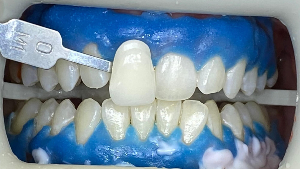 Hogyan válasszuk ki a tökéletes fogszínt? (x)