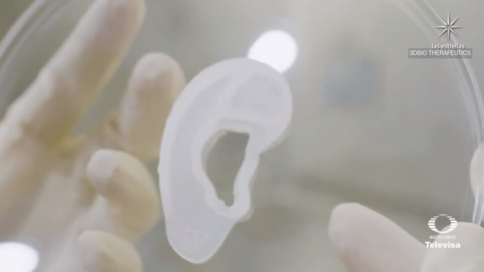 3D-nyomtatott fület kapott egy amerikai nő - videó