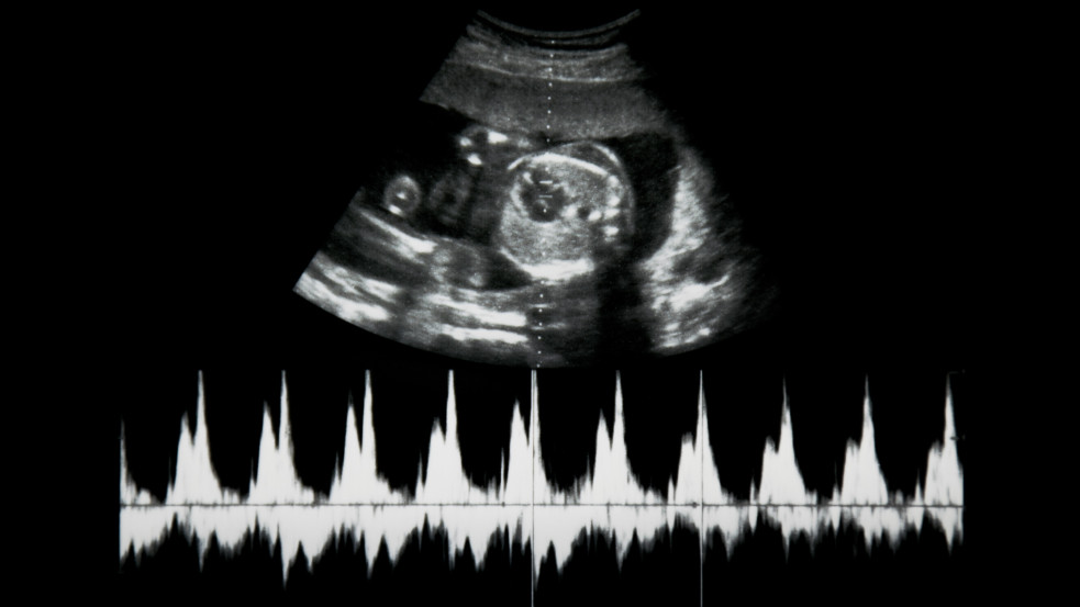 Szülészorvos: a szívhangot hallva sok kismama meggondolja magát