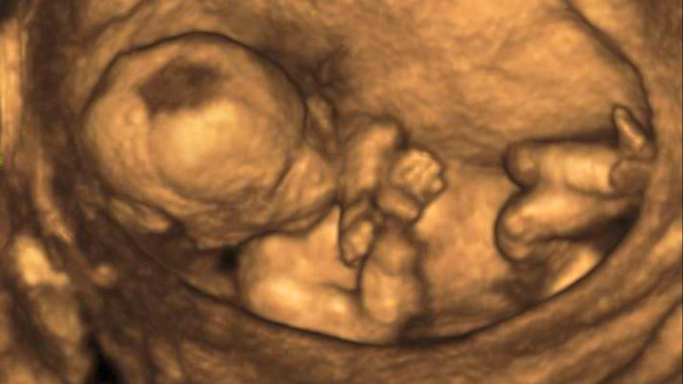 (18+) "Szívet, lábat, agyat" - kormányzati milliókból vehetett ki szerveket abortuszt túlélő gyermekekből egy amerikai elitegyetem